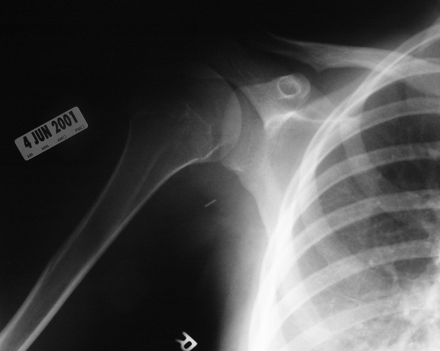 Tumor Surgery Bone Cancer Tumors Surgeon NYC